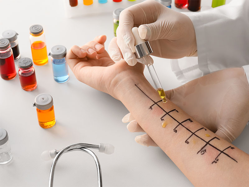 Ein Dermatologe in Hamm testet verschiedene Substanzen beim Allergietest einer Patientin am Unterarm