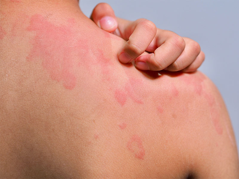 Eine weibliche Patientin wartet beim Hautarzt in Hamm auf die Untersuchung einer juckenden Allergie am oberen Rücken